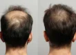 Vampire Hair Restoration at Ascent Aesthetics